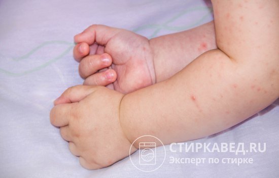 При первом использовании постиранных вещей обратите внимание на кожу младенца. Если на ней появились любые признаки аллергии, немедленно снимите с ребенка одежду, вызовите доктора, а для дальнейших стирок применяйте другое средство
